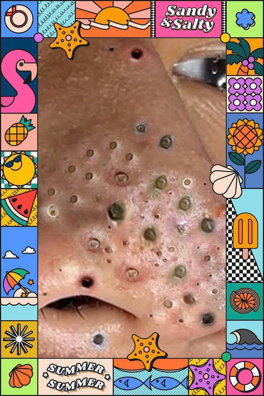 PIMPLE POPPING SEASON 9