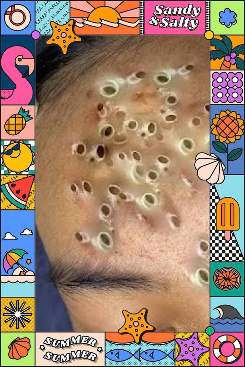 PIMPLE POPPING SEASON 6